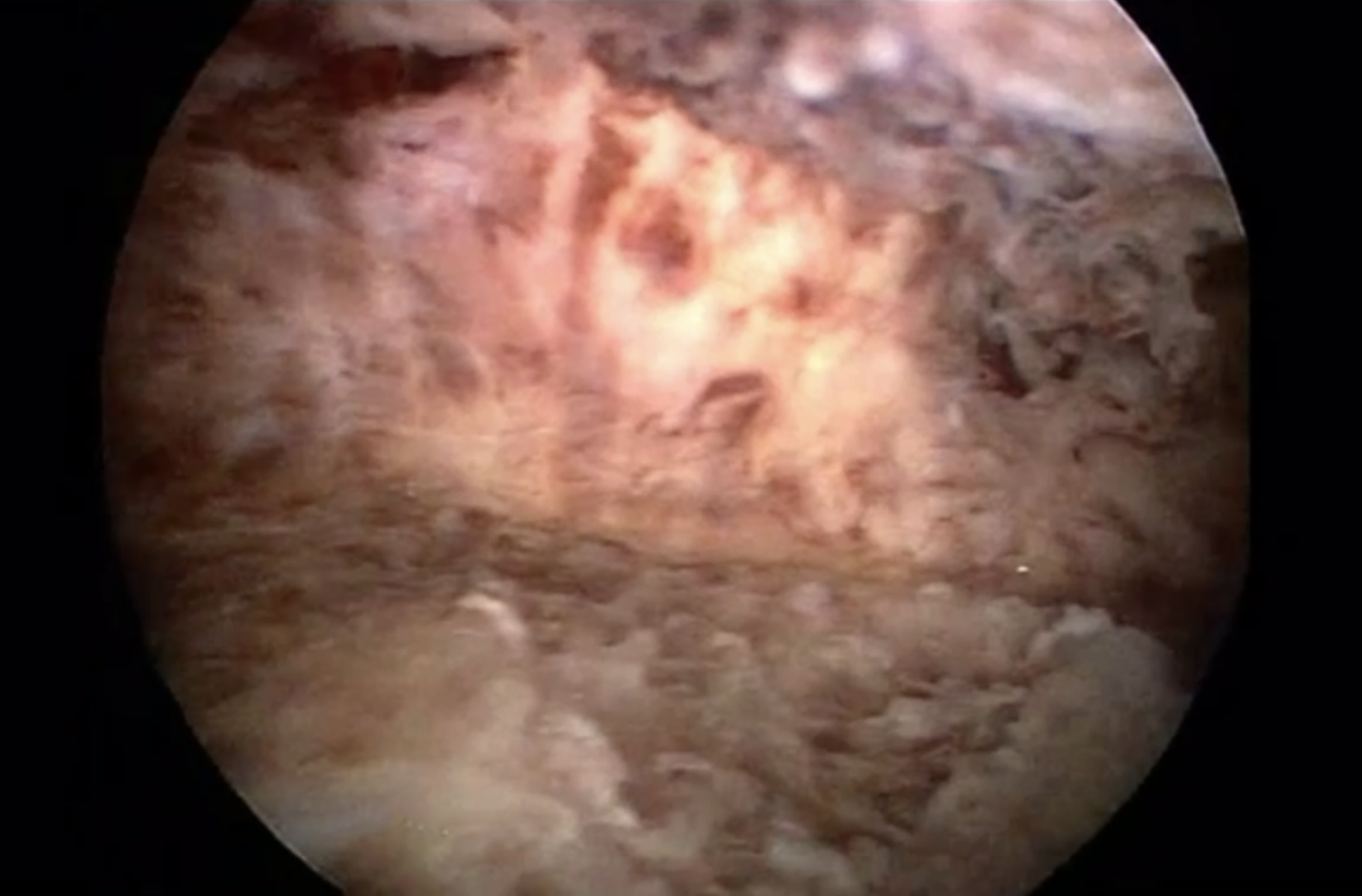 Nach der Novasure Ablation